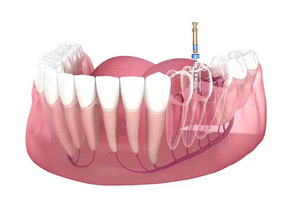 Root Canal Treatment – RCT