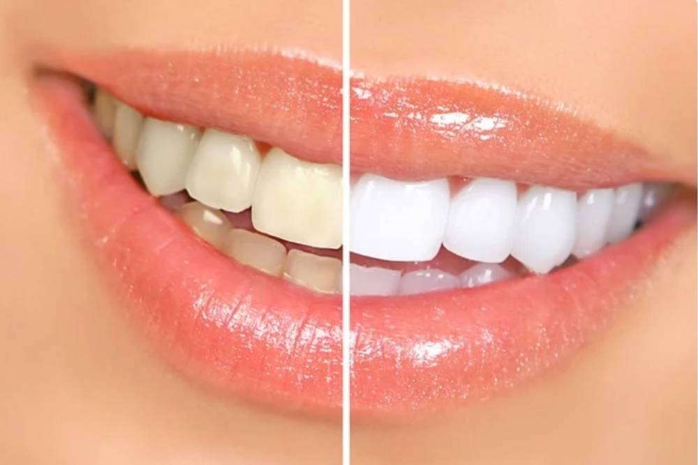 Tooth Whitening