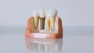 Dental Implants in Kathmandu
